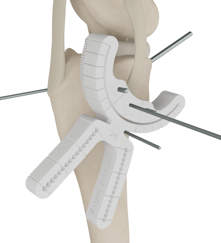 Guided TPLO – OssAbility Limited