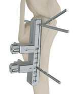 OssAbility | Helping you perform surgery with confidence – OssAbility ...